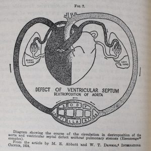Schéma en noir et blanc du système cardiovasculaire montrant un défaut du septum ventriculaire et dextroposition de l’aorte, encre noire sur papier blanc. 