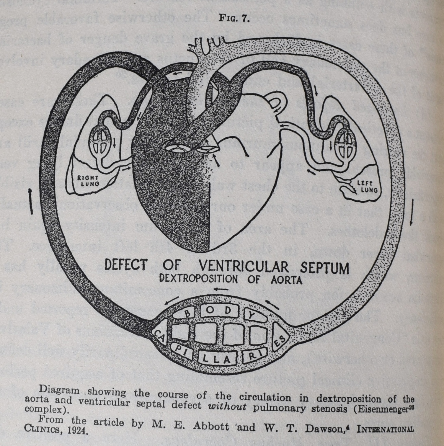 Black and white diagram of the cardiovascular system showing a defect of the ventricular septum and dextroposition of the aorta; black ink on white paper.