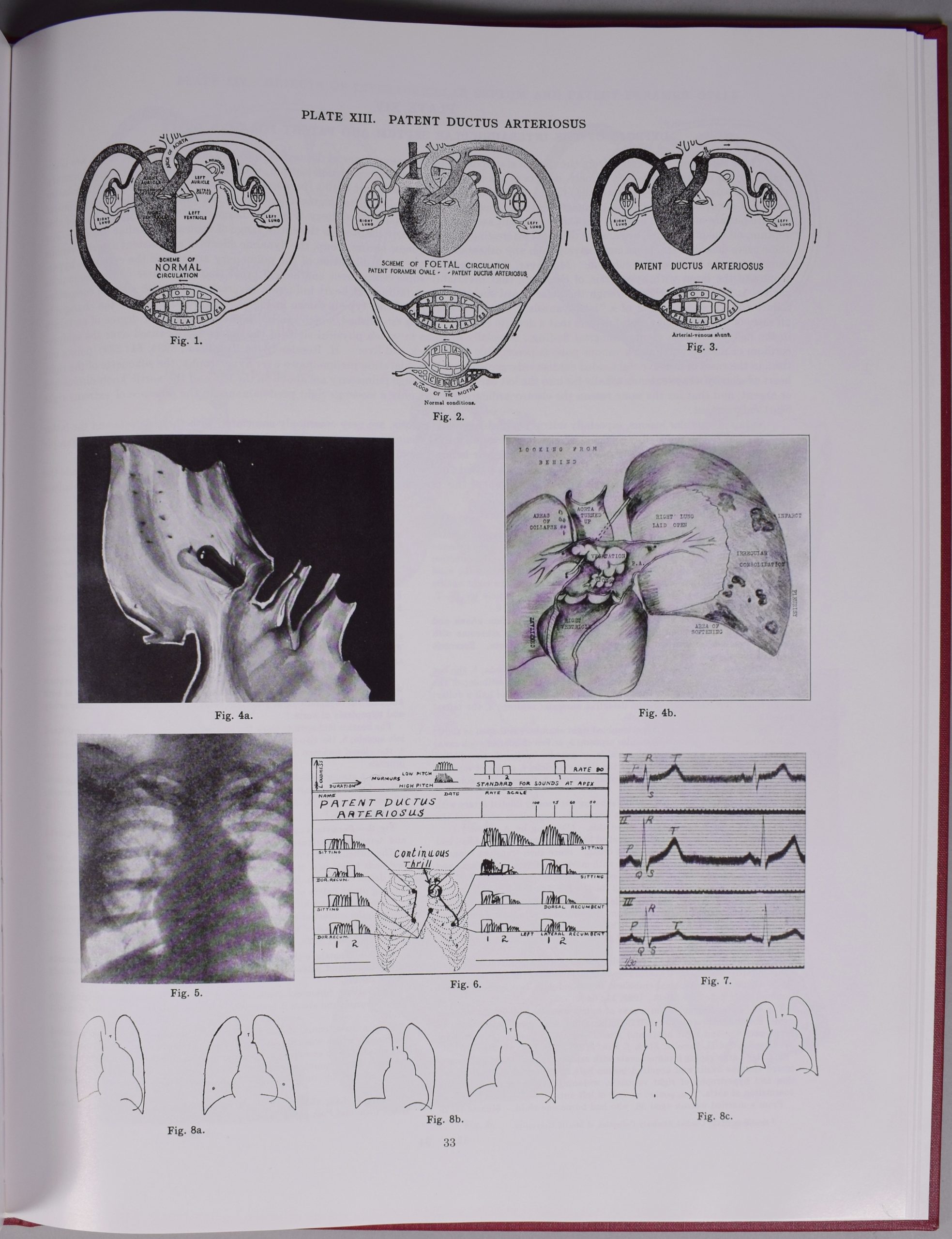 Photograph of page 33 of the Atlas of Congenital Cardiac Disease by Maude Abbott, black and white. The page is titles “Plate XIII. Patent Ductus Arteriosus” and contains 11 figures illustrating cardiac arteries.