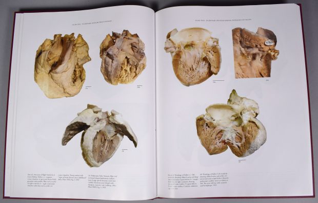 Colour photograph of two pages of Maude Abbott’s Atlas of Congenital Cardiac Disease. The page on the left, “Plate XVII Pulmonary Outflow Tract Stenosis”, and the one on the right, “Plate VXIII Pulmonary Stenosis/Atresia (Tetralogy of Fallot)”, present heart specimens in colour, with explanations at the bottom of the page.