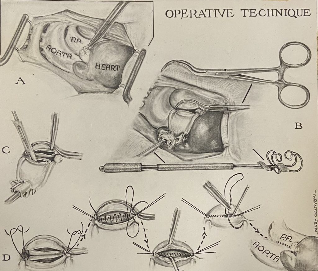 Black and white illustration of an aorta being cut open and then stitched shut. It consists of a series of small illustrations showing the process in sequence.