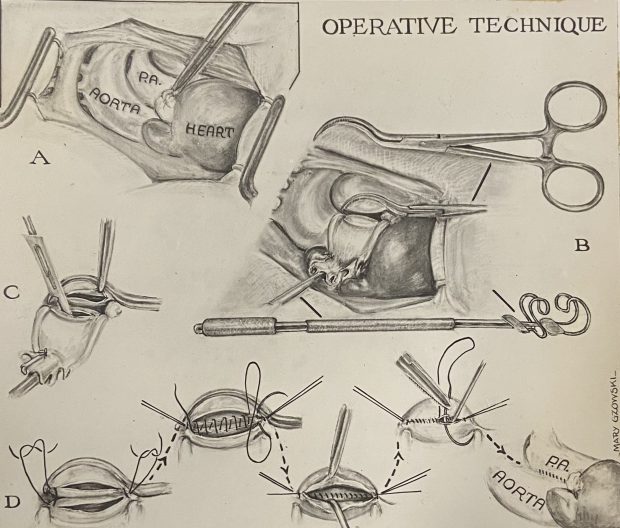 Black and white illustration of an aorta being cut open and then stitched shut. It consists of a series of small illustrations showing the process in sequence.
