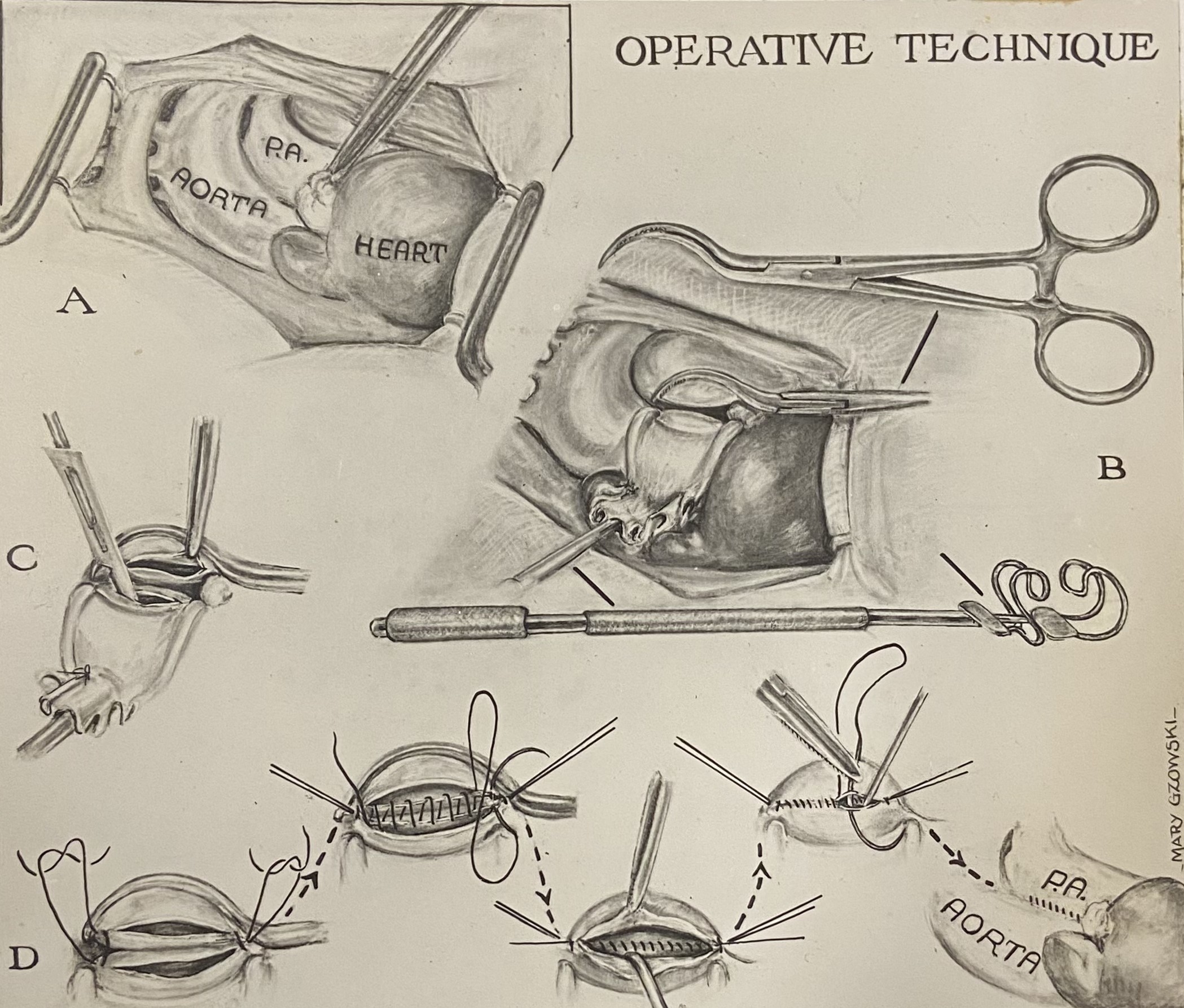 Black and white illustration of an aorta being cut open and then stitched shut. It consists of a series of small illustrations showing the process in sequence.