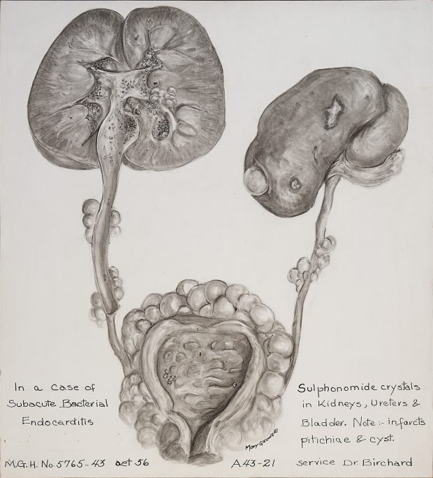 Black and white illustration of sulphonomide crystals in kidneys, ureters and bladder.