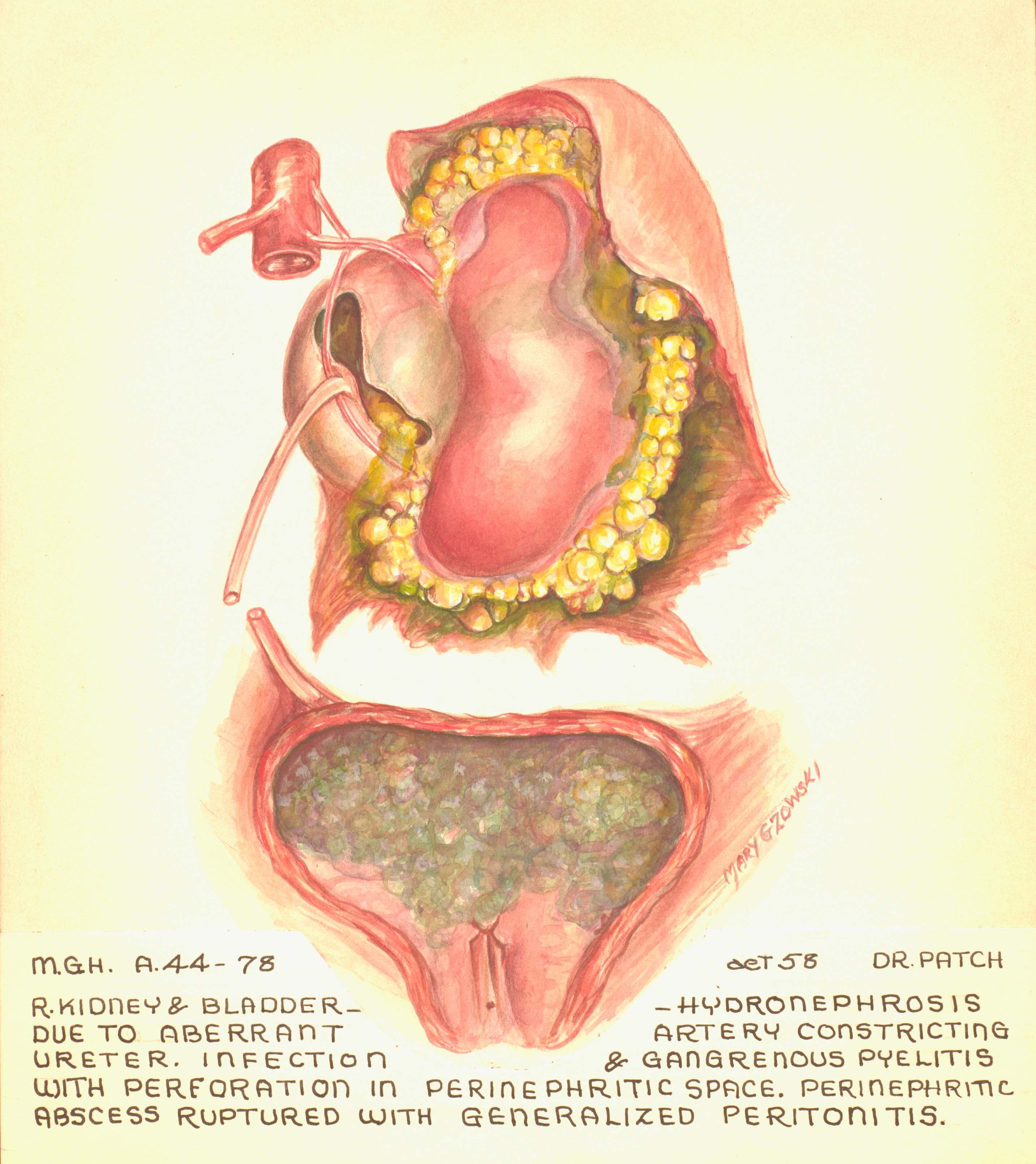Colour illustration of right kidney and bladder depicting hydronephrosis.
