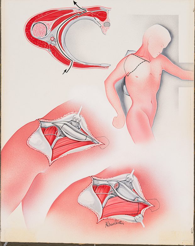 Colour medical illustration of the muscles and ligaments in the shoulder by Helen MacArthur.