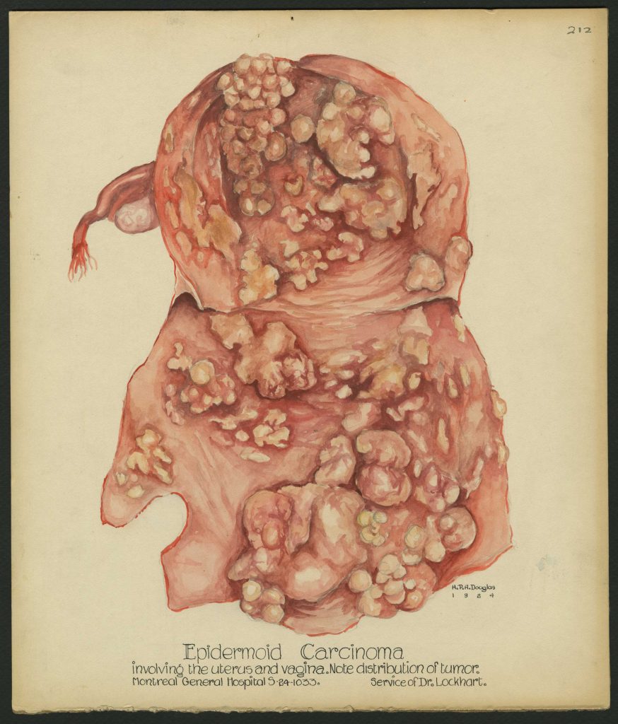 Medical illustration done in watercolour in red and orange tones depicting a uterine condition. Illustration is labelled at bottom centre and signed and dated on the right below the illustration.
