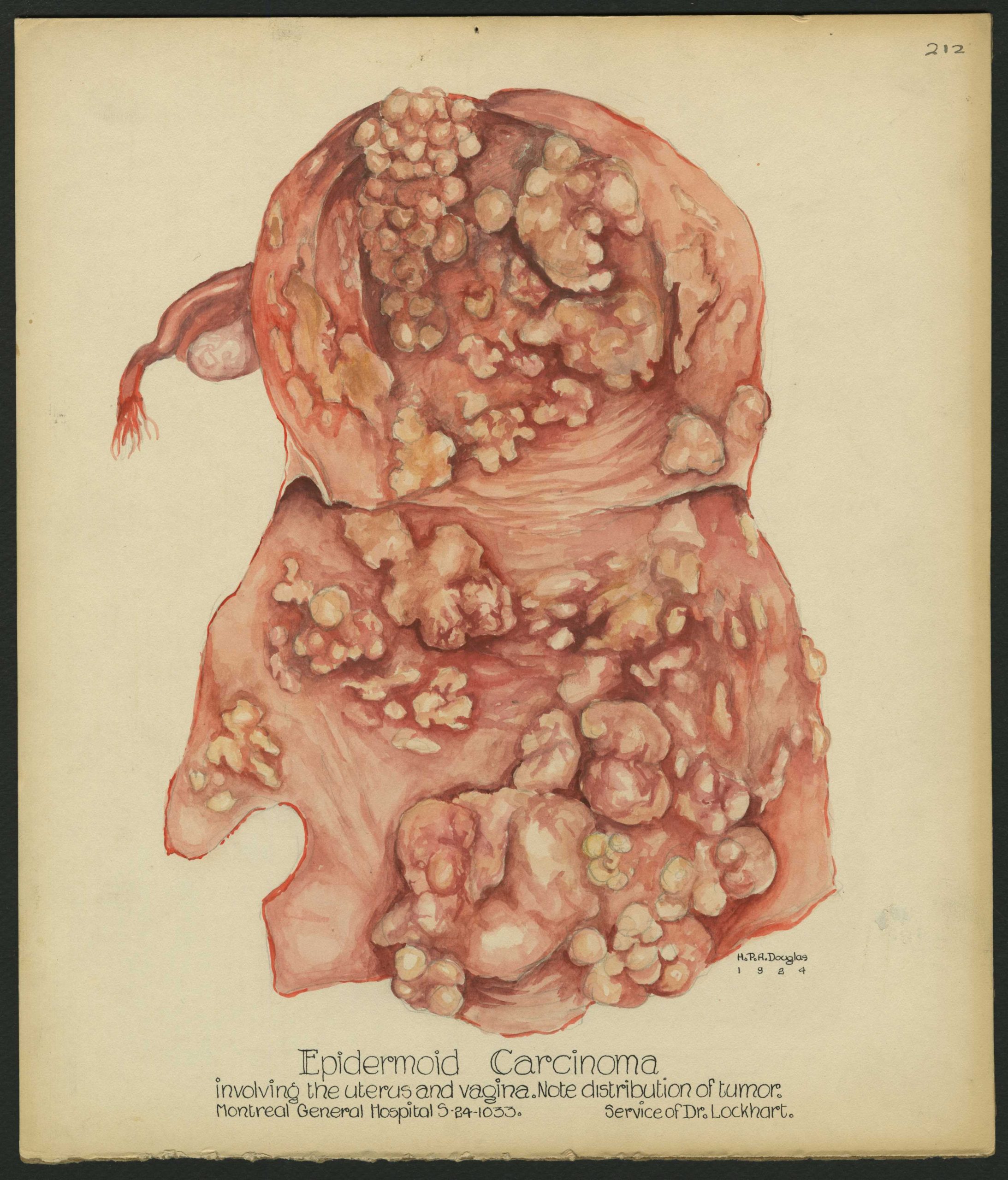 Medical illustration done in watercolour in red and orange tones depicting a uterine condition. Illustration is labelled at bottom centre and signed and dated on the right below the illustration.