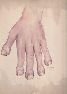 Illustration médicale réalisée à l'aquarelle dans des tons violets et pêche, montrant une main aux doigts enflés et aux ongles abîmés. Signée et datée en bas à droite.