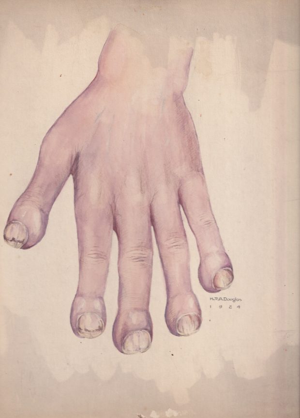 Medical illustration done in watercolour in purple and peach tones, depicting a hand with swollen fingertips and deteriorating fingernails. Signed and dated at the bottom right of the illustration.