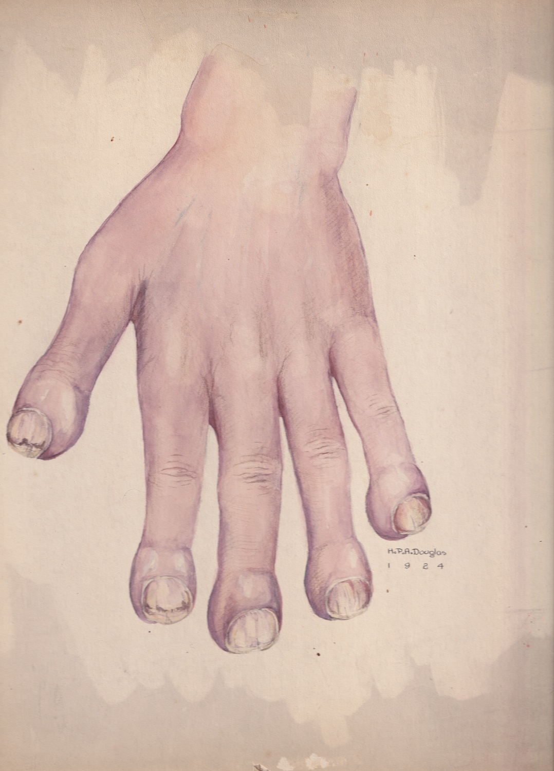 Medical illustration done in watercolour in purple and peach tones, depicting a hand with swollen fingertips and deteriorating fingernails. Signed and dated at the bottom right of the illustration.
