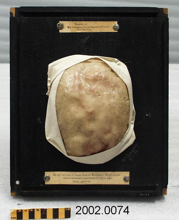Colour photo of a medical moulage of a lumpy scalp mounted on a black board.