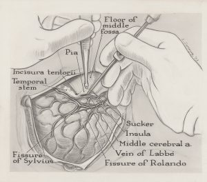 Black and white illustration of gloved hands operating on a brain.
