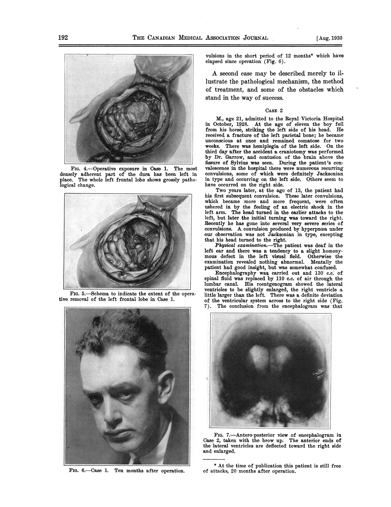 Black and white journal article showing a man's face and an open skull with exposed brain.