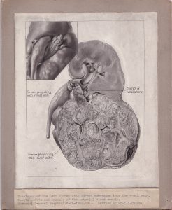 Illustration médicale en noir et blanc montée sur carton gris, avec une étiquette apposée sous le dessin. Le dessin, qui présente une maladie rénale, est réalisé à la poudre de carbone et signé en bas à droite.