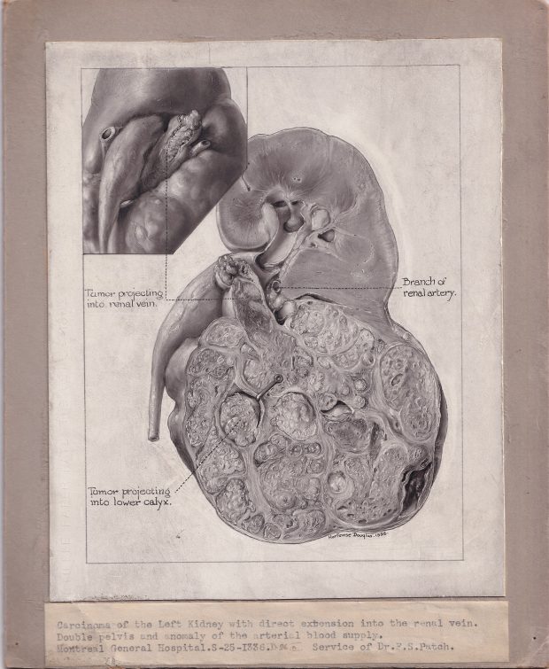 Black and white medical illustration mounted on grey board, with separate label attached to the board below drawing. Drawing is done in carbon dust and depicts a kidney conditions. Signed at the lower right.