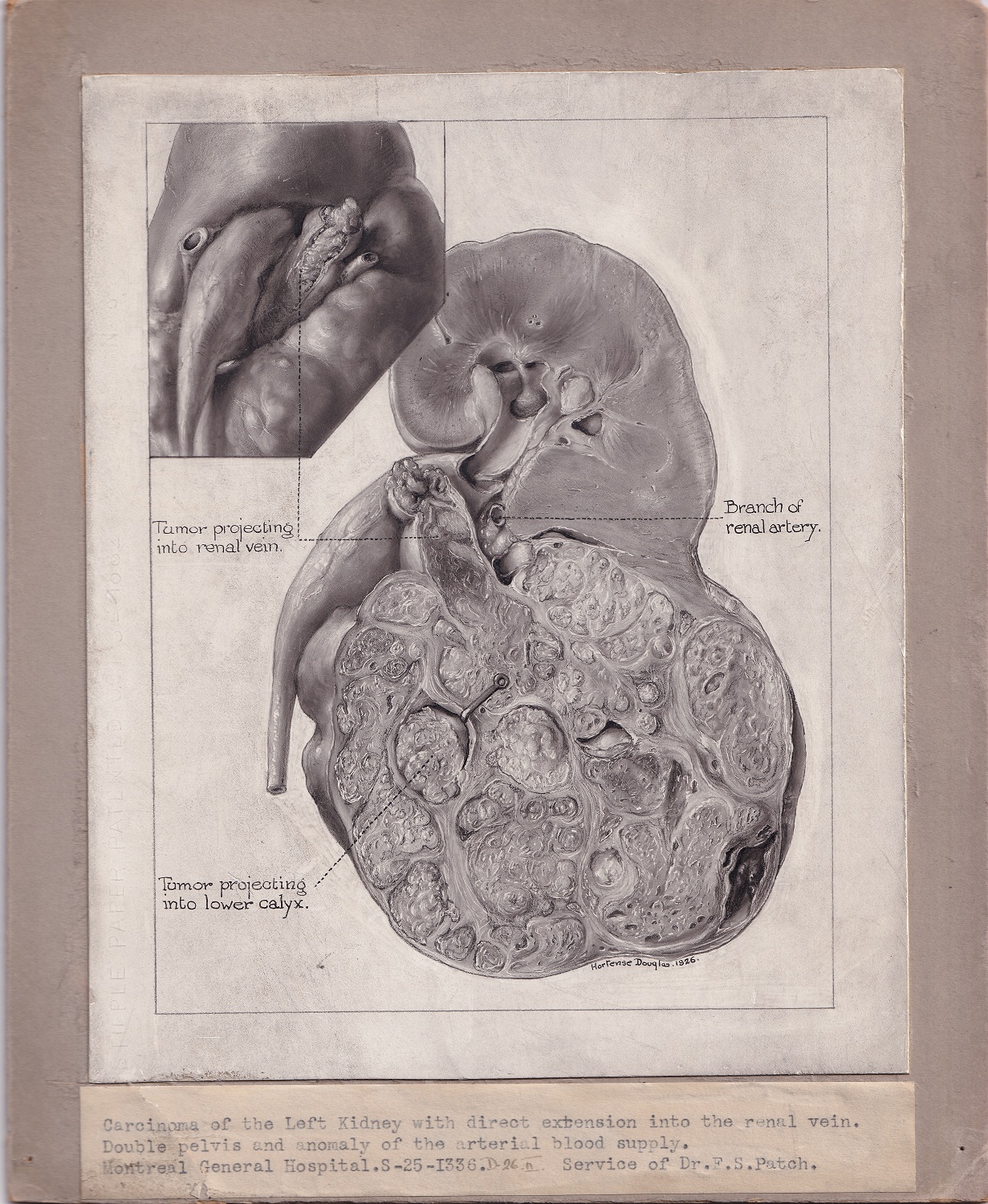Black and white medical illustration mounted on grey board, with separate label attached to the board below drawing. Drawing is done in carbon dust and depicts a kidney conditions. Signed at the lower right.
