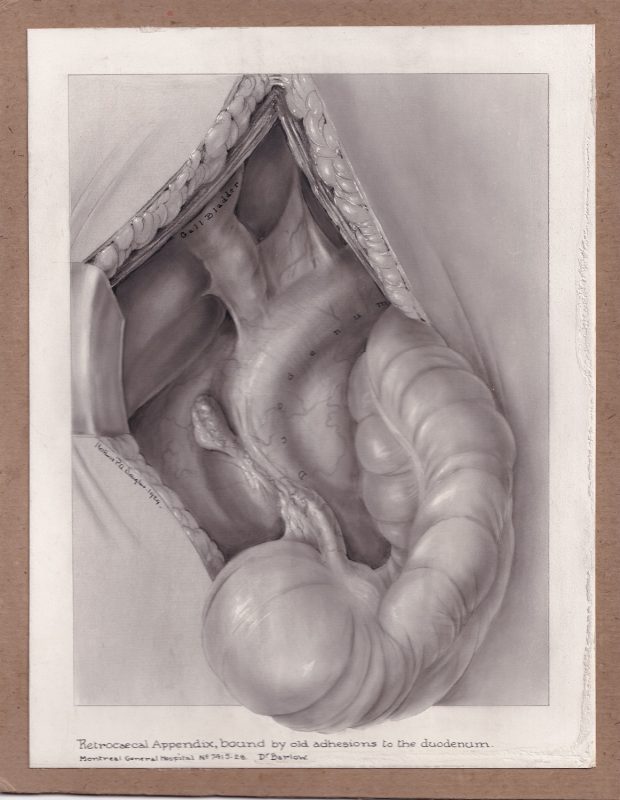 Black and white medical illustration done in carbon dust mounted on brown board. White border of the paper surrounds the drawing, which is contained within a rectangle. One element of the drawing surpasses the border of the rectangle. Drawing is labelled below and within image and signed middle left.