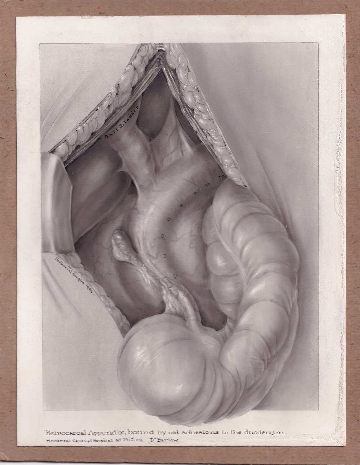 Black and white medical illustration done in carbon dust mounted on brown board. White border of the paper surrounds the drawing, which is contained within a rectangle. One element of the drawing surpasses the border of the rectangle. Drawing is labelled below and within image and signed middle left.