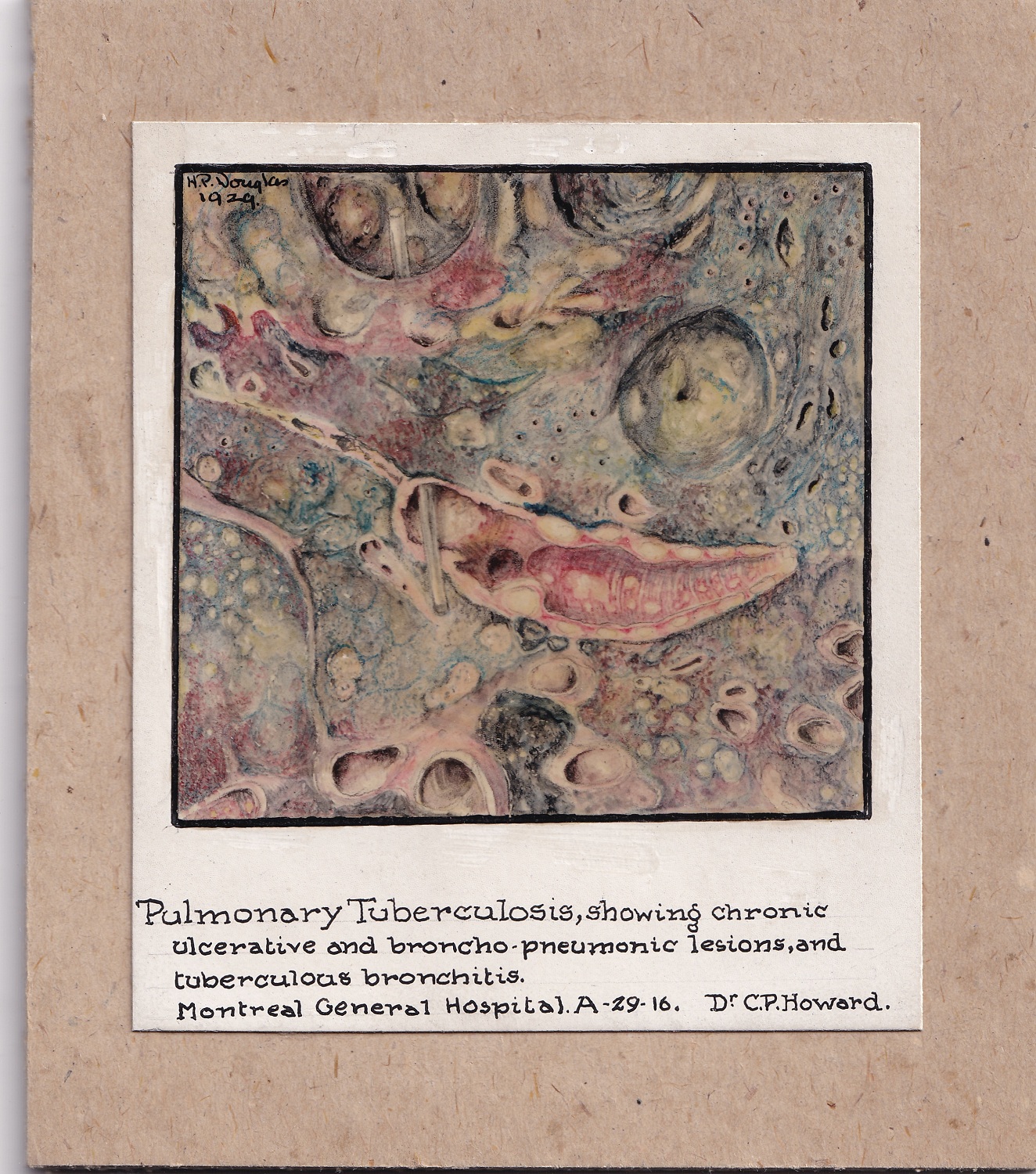 Medical illustration done in coloured pencil. Paper is mounted on brown board and drawing is bordered in black. Labelled beneath the drawing and signed at the top left.
