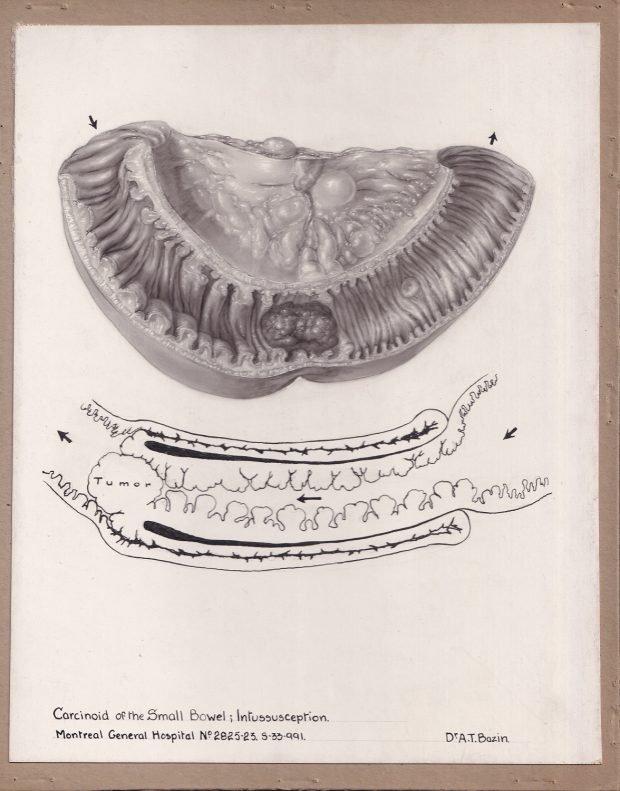 Black and white medical illustration done in multiple mediums, illustrating a bowel condition. Upper illustation is done in carbon dust; lower drawing is done in linework. Labelled at the bottom of drawing.