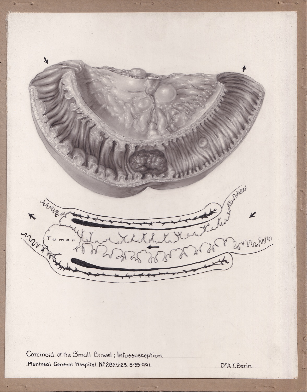 Black and white medical illustration done in multiple mediums, illustrating a bowel condition. Upper illustation is done in carbon dust; lower drawing is done in linework. Labelled at the bottom of drawing.