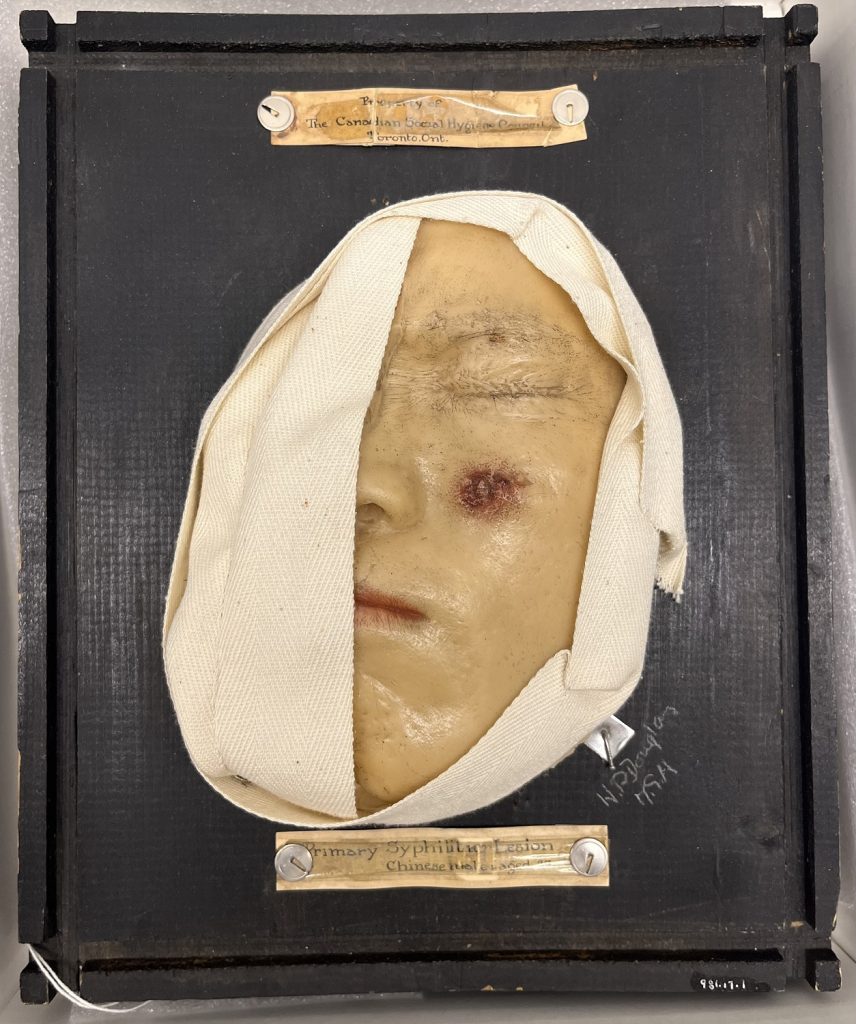 Colour photo of a medical moulage of a man's face with a red sore on his cheek, mounted on a black board.