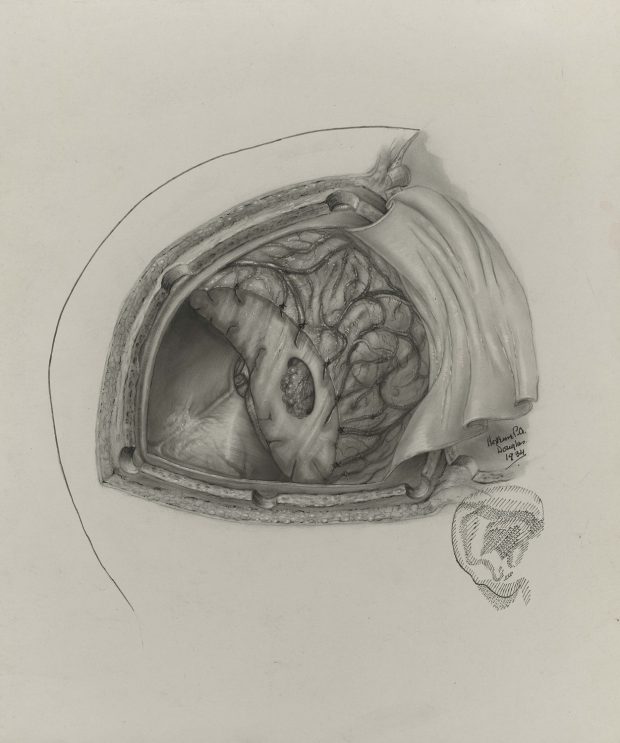 Black and white medical illustration showing bird's-eye view of a neurological operation. Signed and dated at the bottom right of the illustrated area.