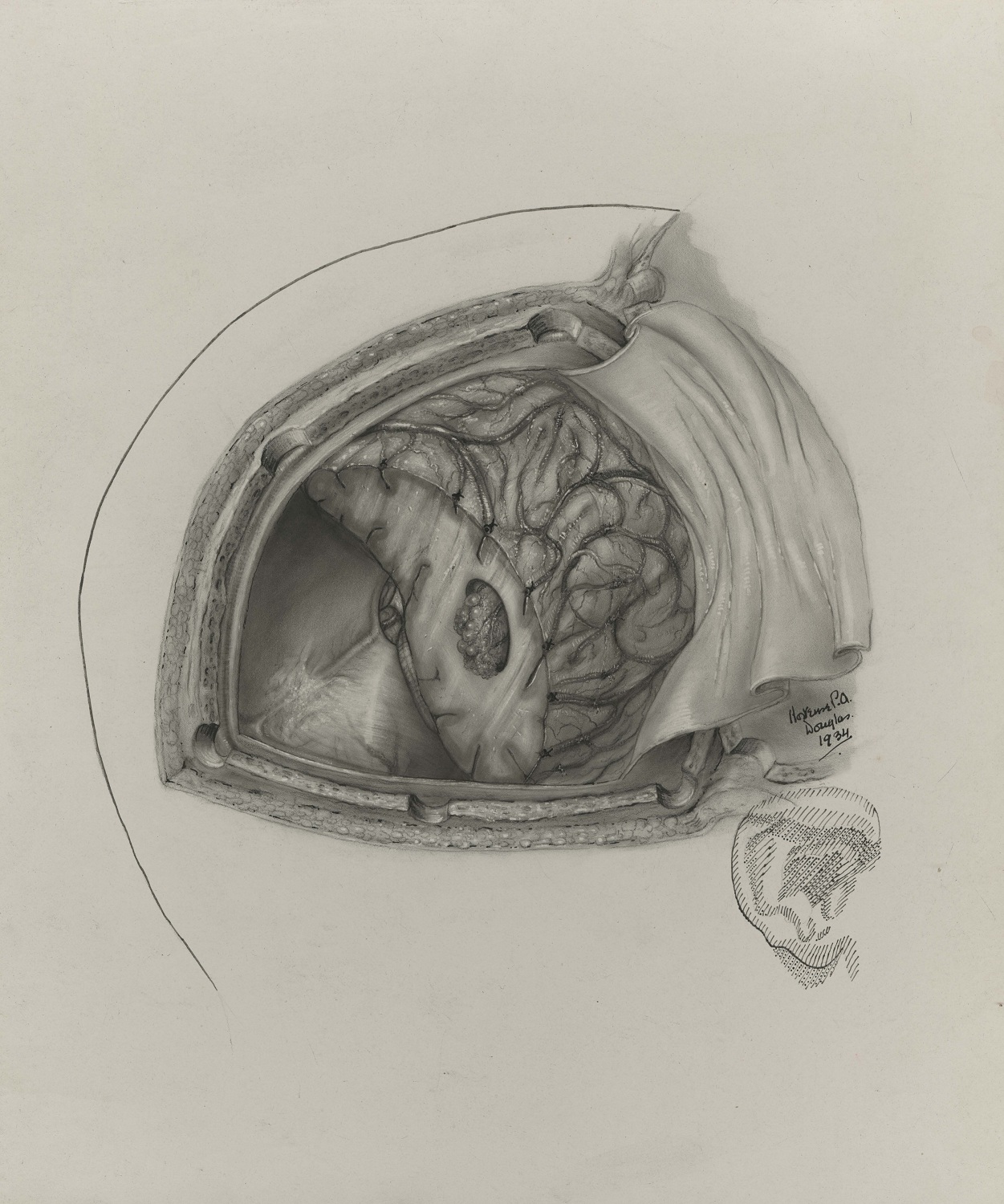Black and white medical illustration showing bird's-eye view of a neurological operation. Signed and dated at the bottom right of the illustrated area.