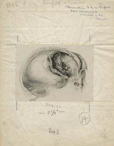 Illustration médicale en noir et blanc d’un crâne, signée et datée en bas à gauche, montée sur du papier journal froissé, avec des notes de publication.