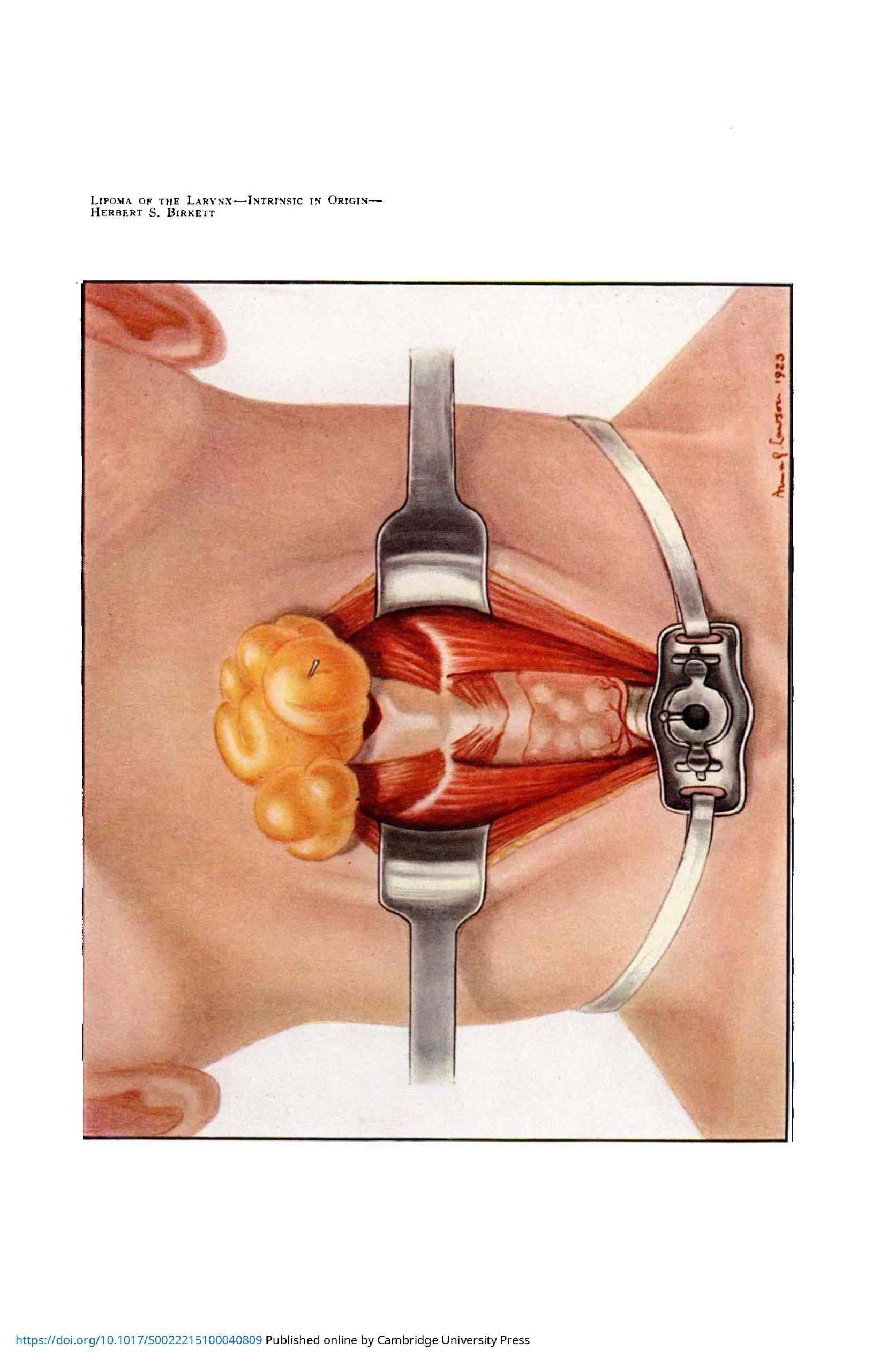 Colour medical illustration of a throat being held open by forceps during surgery. At the bottom of the throat is a tracheotomy aperture.