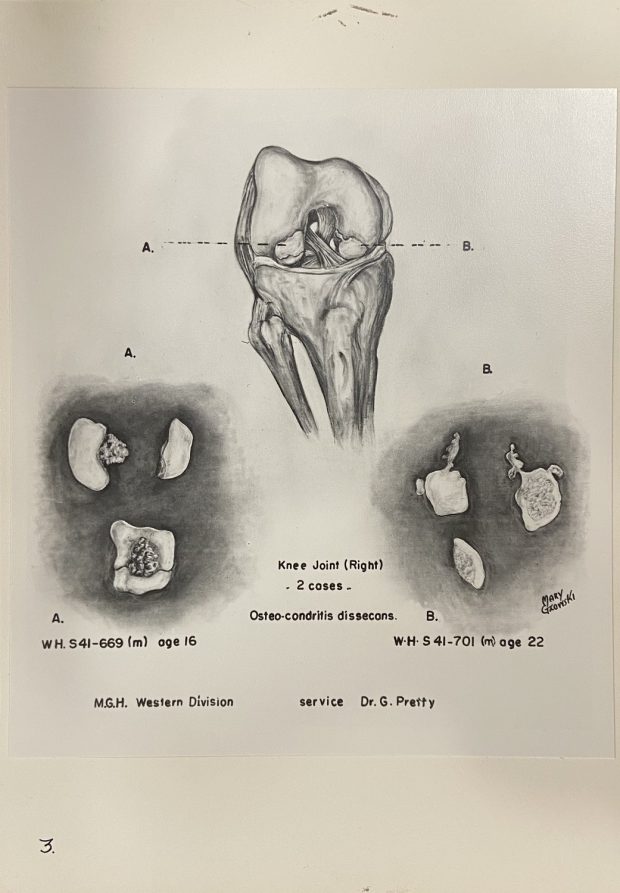 Black and white illustration of a knee joint, consisting of three images; one illustration of the whole knee joint and two close-up illustrations of pieces of the joint.