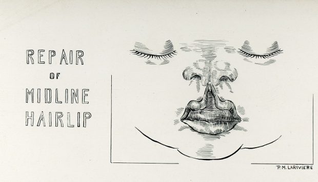 Black and white illustration of a child's face whose upper lip is split and raised towards the nose. On the far left is the title, Repair of Midline Hairlip, and on the far right a signature, Pauline M. Larivière.