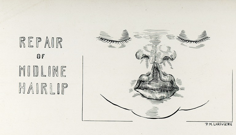 Black and white illustration of a child's face whose upper lip is split and raised towards the nose. On the far left is the title, "Repair of Midline Hairlip," and on the far right a signature, "Pauline M. Larivière."