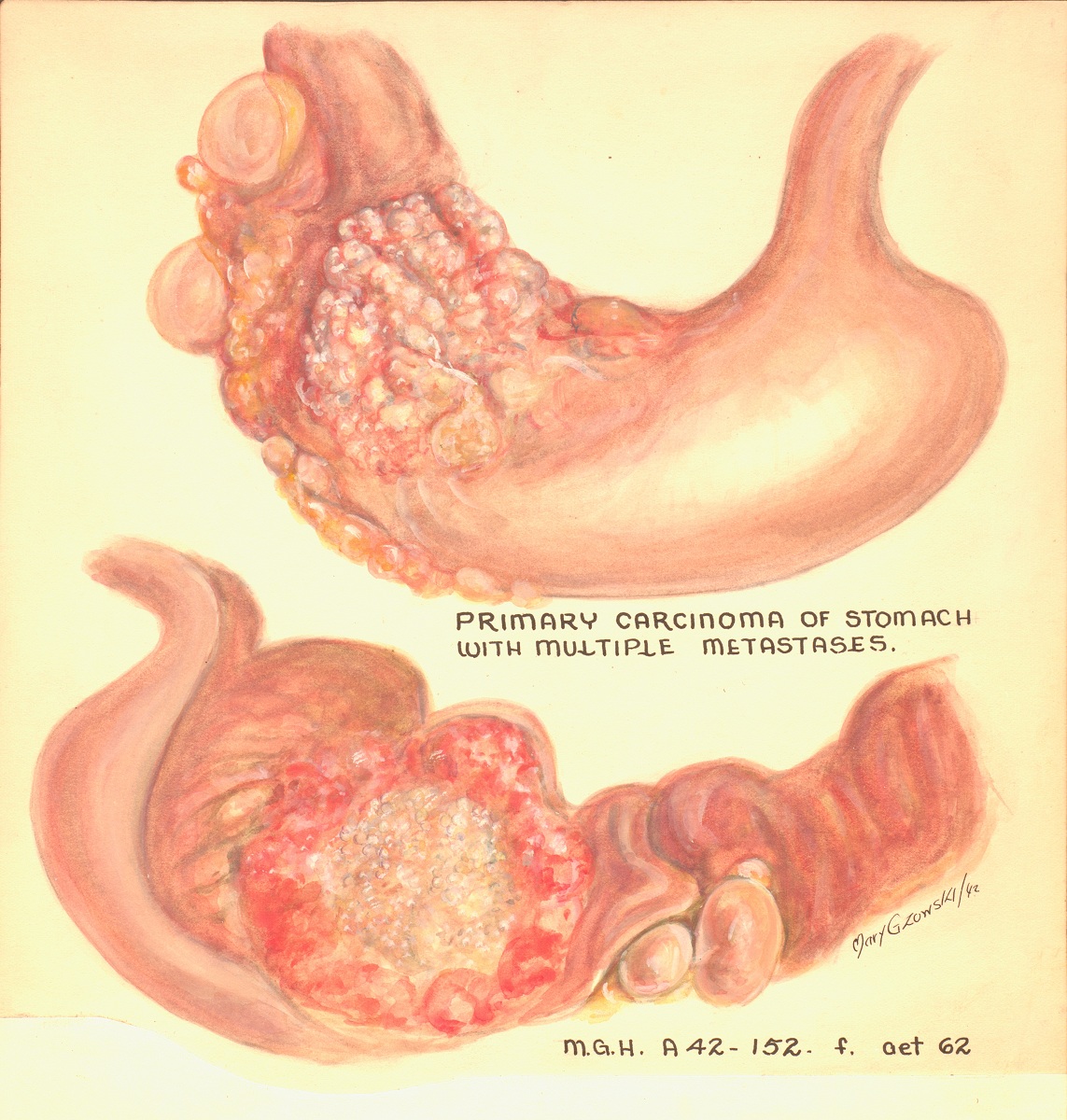 Colour illustration of the stomach depicting cancerous growths.