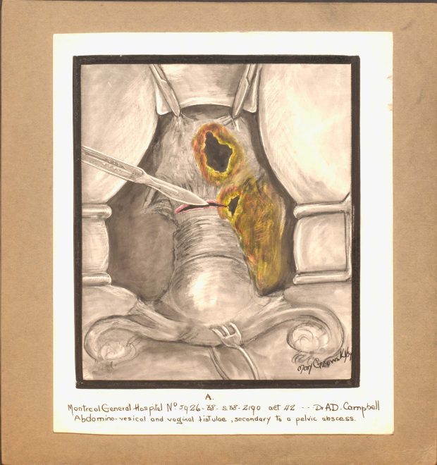 Colour illustration of the abdomino-vesical and vaginal tistulae. Forceps are holding the cavity open while the surgeon uses a scalpel.