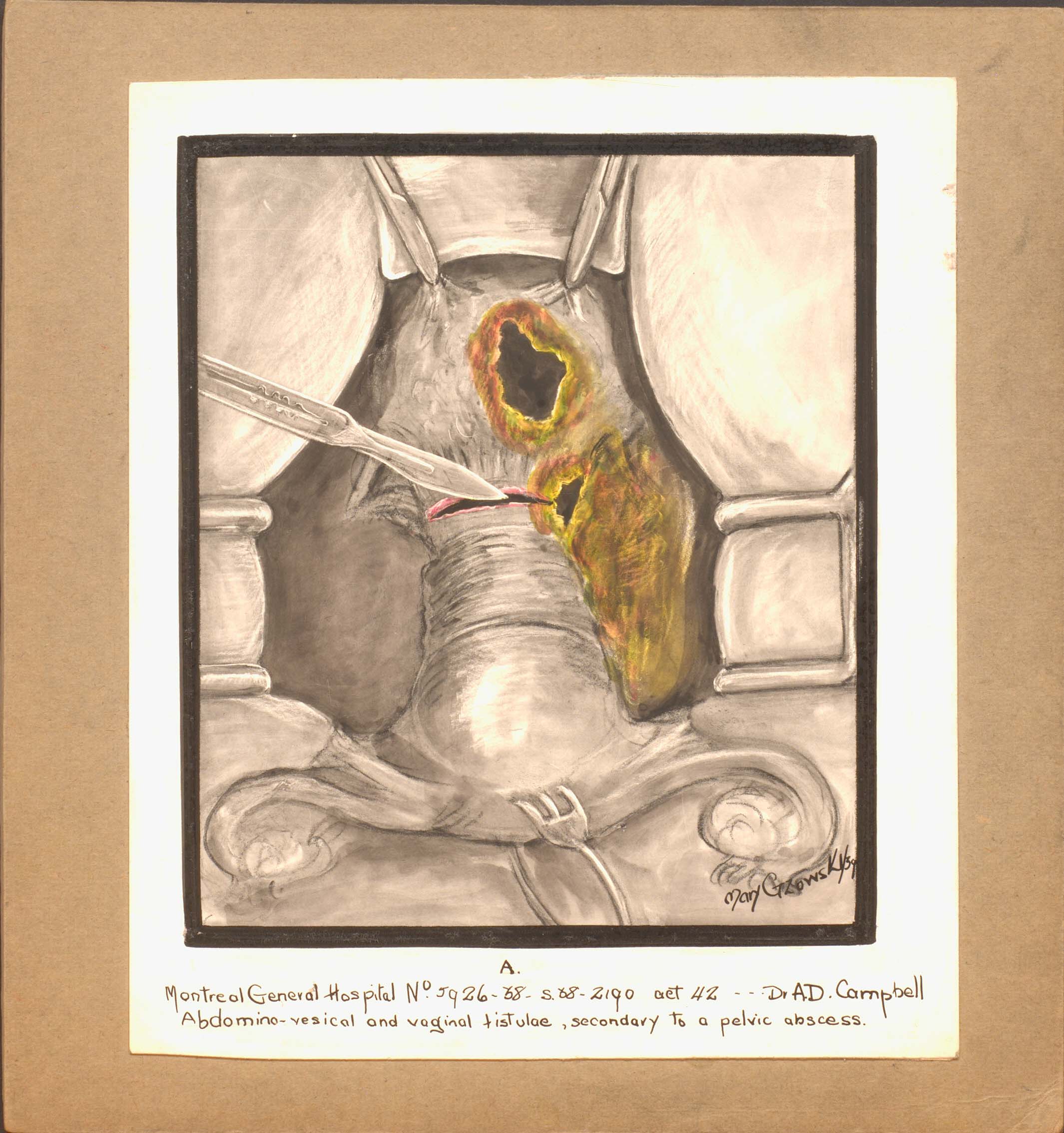Colour illustration of the abdomino-vesical and vaginal tistulae. Forceps are holding the cavity open while the surgeon uses a scalpel.