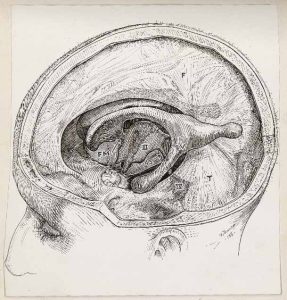 Illustration médicale réalisée au stylo montrant un crâne ouvert et une partie du cerveau.