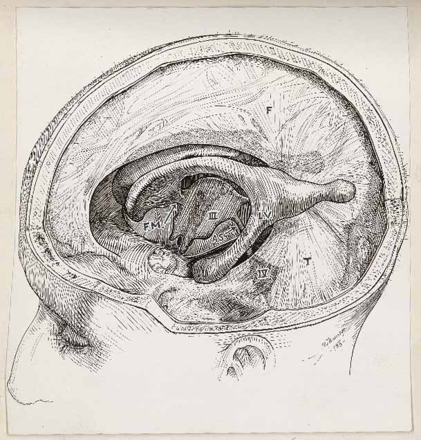 Medical illustration done in pen showing an open skull and section of the brain.