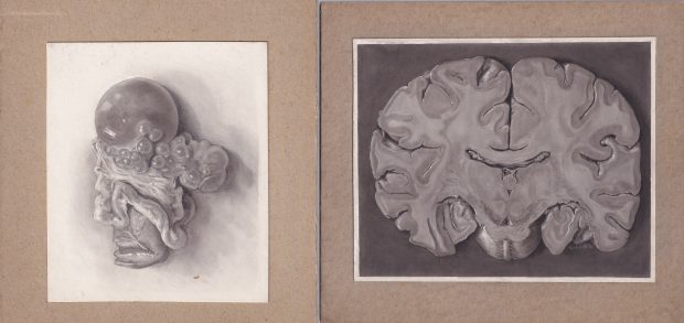 Two tonal medical illustrations done in carbon dust on cream paper, mounted on board.