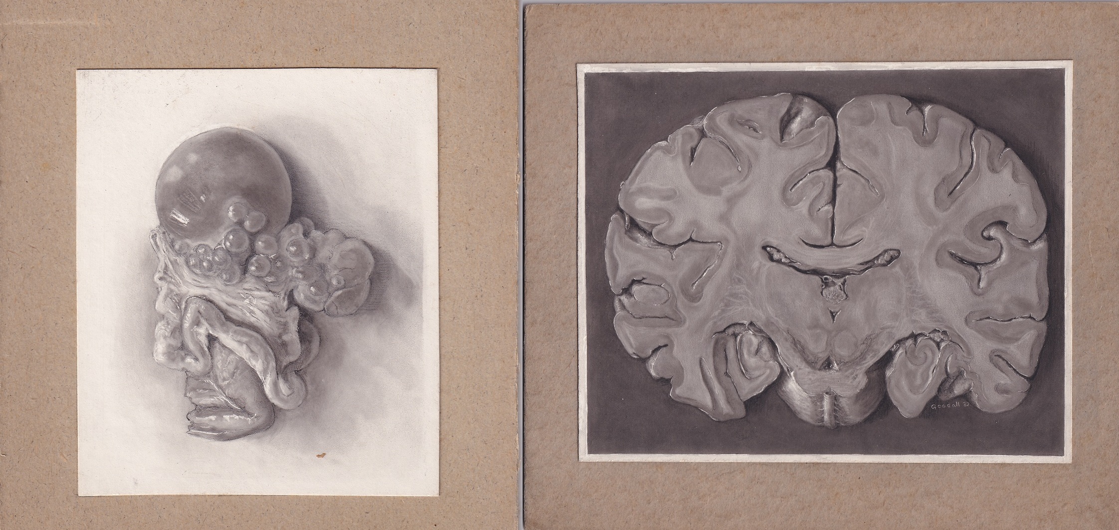 Two tonal medical illustrations done in carbon dust on cream paper, mounted on board.