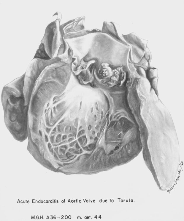 Black and white illustration showing the aortic valve.